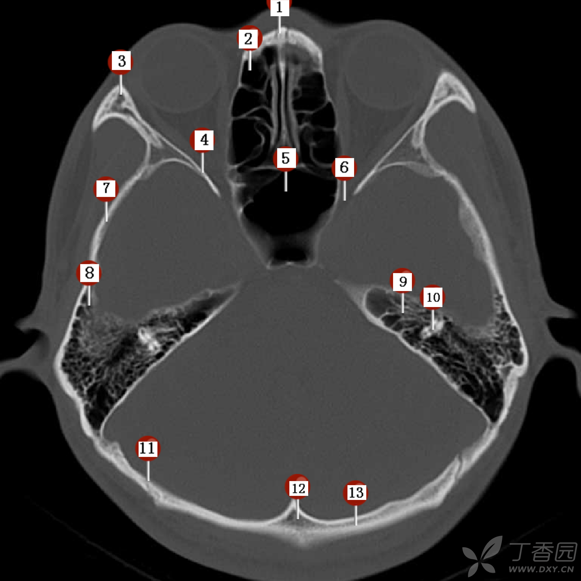 颅脑 CT 读片 纯干货 - 影像医学和核医学讨论版 -丁香园论坛