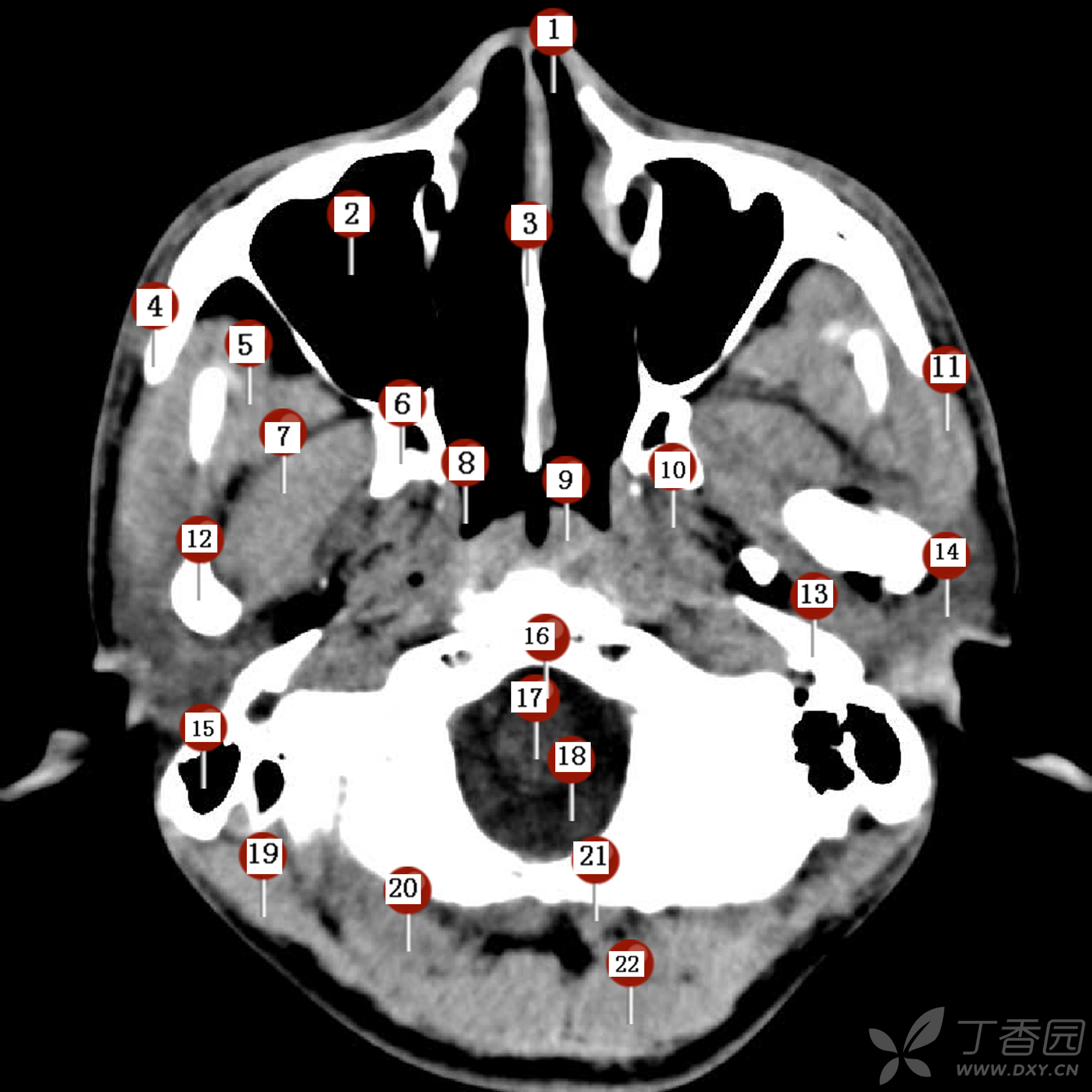 六、脑CT灌注成像的应用|上海大学附属上海全景云医学影像诊断中心|全景医学影像