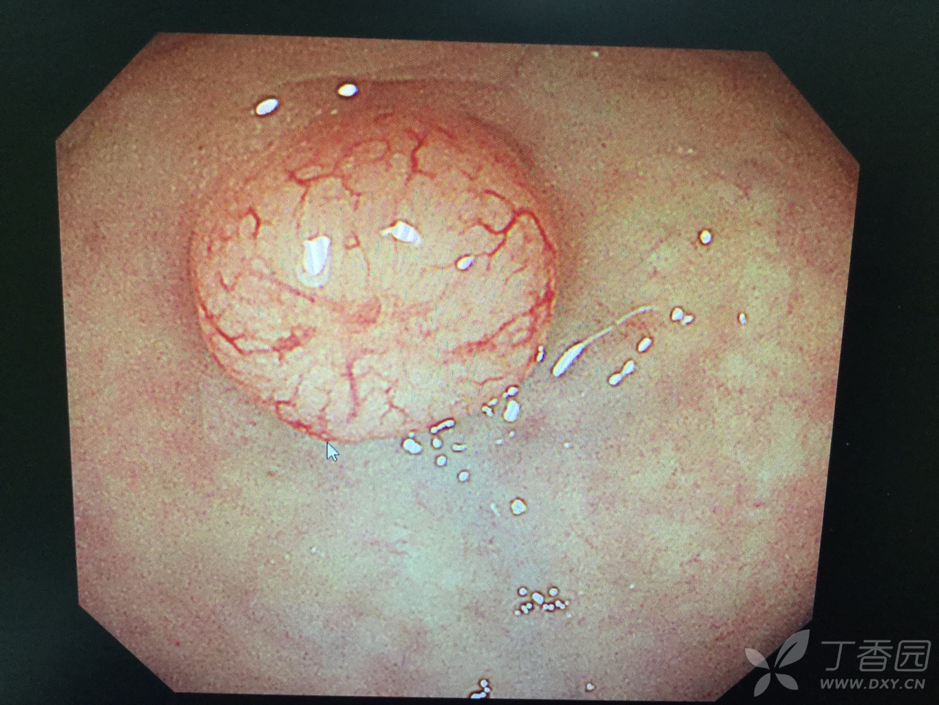 直肠息肉 ptgc 直肠良性淋巴瘤