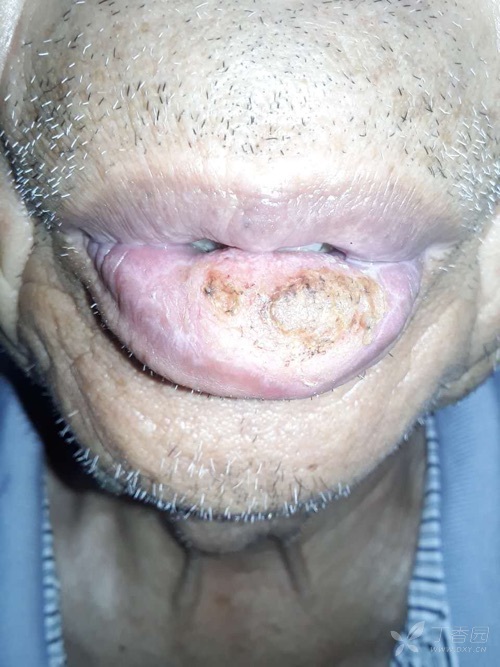 嘴唇肿瘤图片图片
