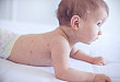 热退疹出：幼儿急疹鉴别诊断 6 大要点（附图）