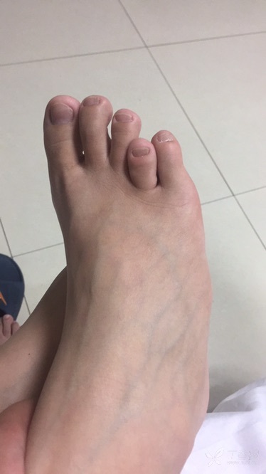 足趾畸形一例,如何诊断?