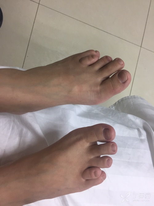 足趾畸形一例,如何诊断?