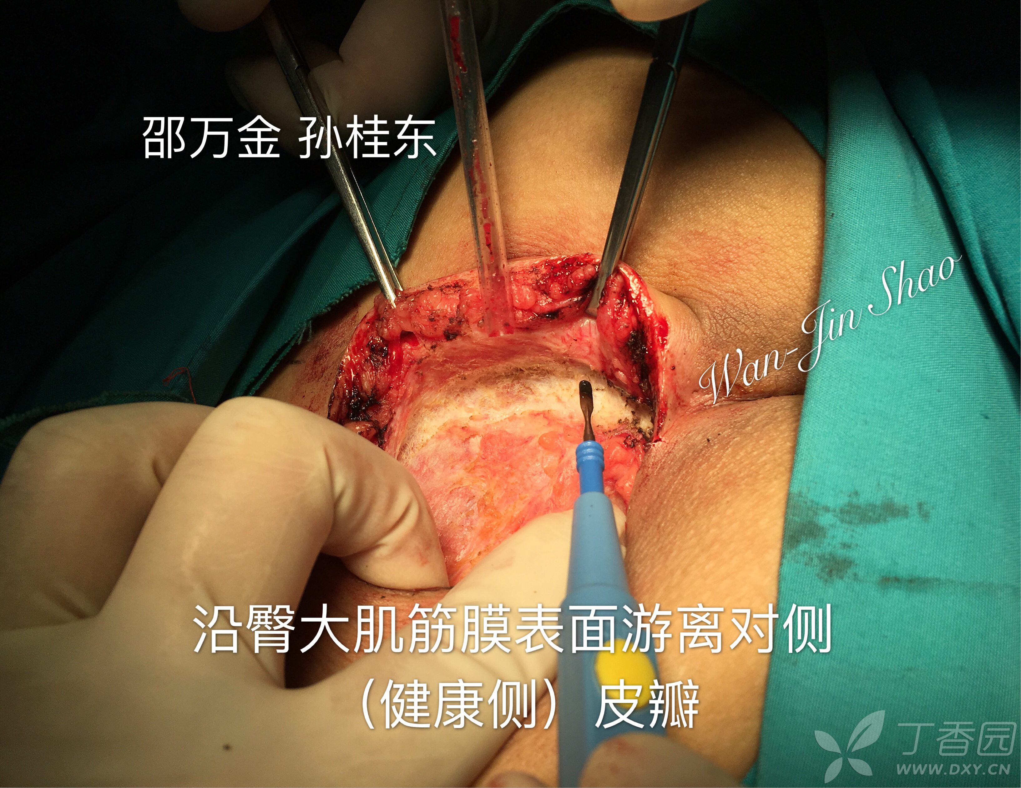 藏毛窦改良karydakis皮瓣技术