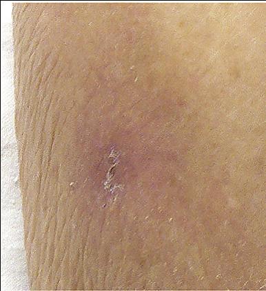 血管炎样皮疹 典型图片：由血管炎患者新发皮疹所确诊出的结核感染