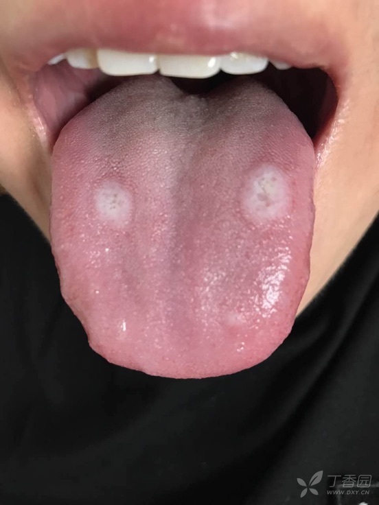 皮肤与性传播疾病讨论版 相关疾病: 扁平苔藓 白塞病 粘膜白斑 口腔