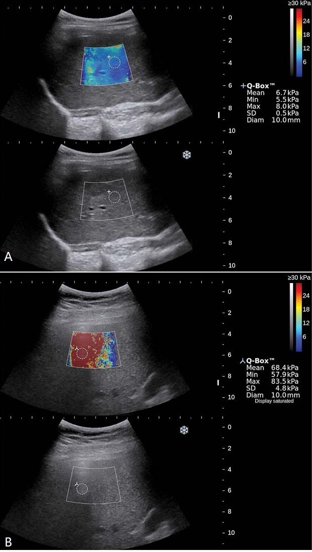 肝脏超声印象和瞬时弹性成像检测 肝脏超声弹性查看：临床医师需求知道什么
