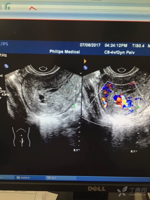 子宫动静脉瘘彩超图像图片