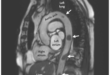 移动性主动脉血栓，你见过吗？