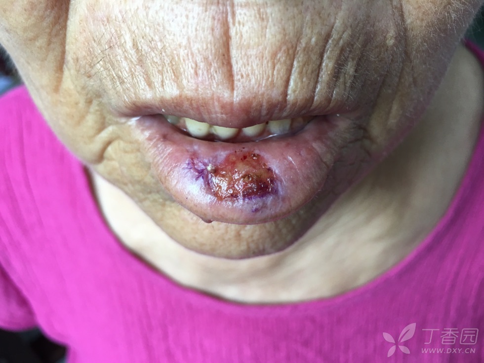 唇癌初期图片
