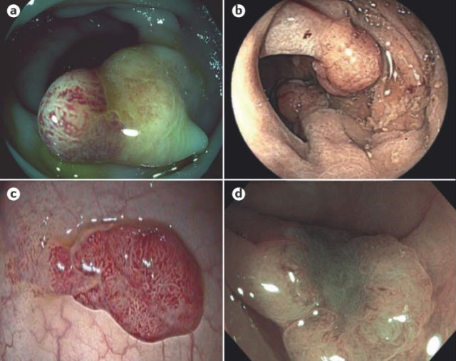 胃肠道内镜 大显神通的胃肠道肿瘤多模式内镜成像技术