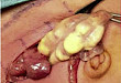 出生28天的新生儿患者，术中见其一段肠管呈乳酪色……