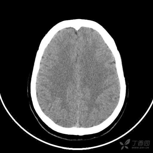 颞叶脑膜瘤图片