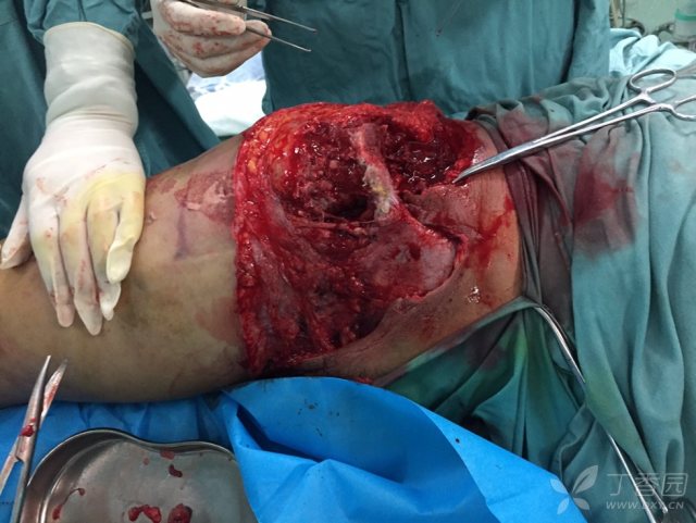 啥是开放性创伤 3222567151338088510-16w.jpg!w640