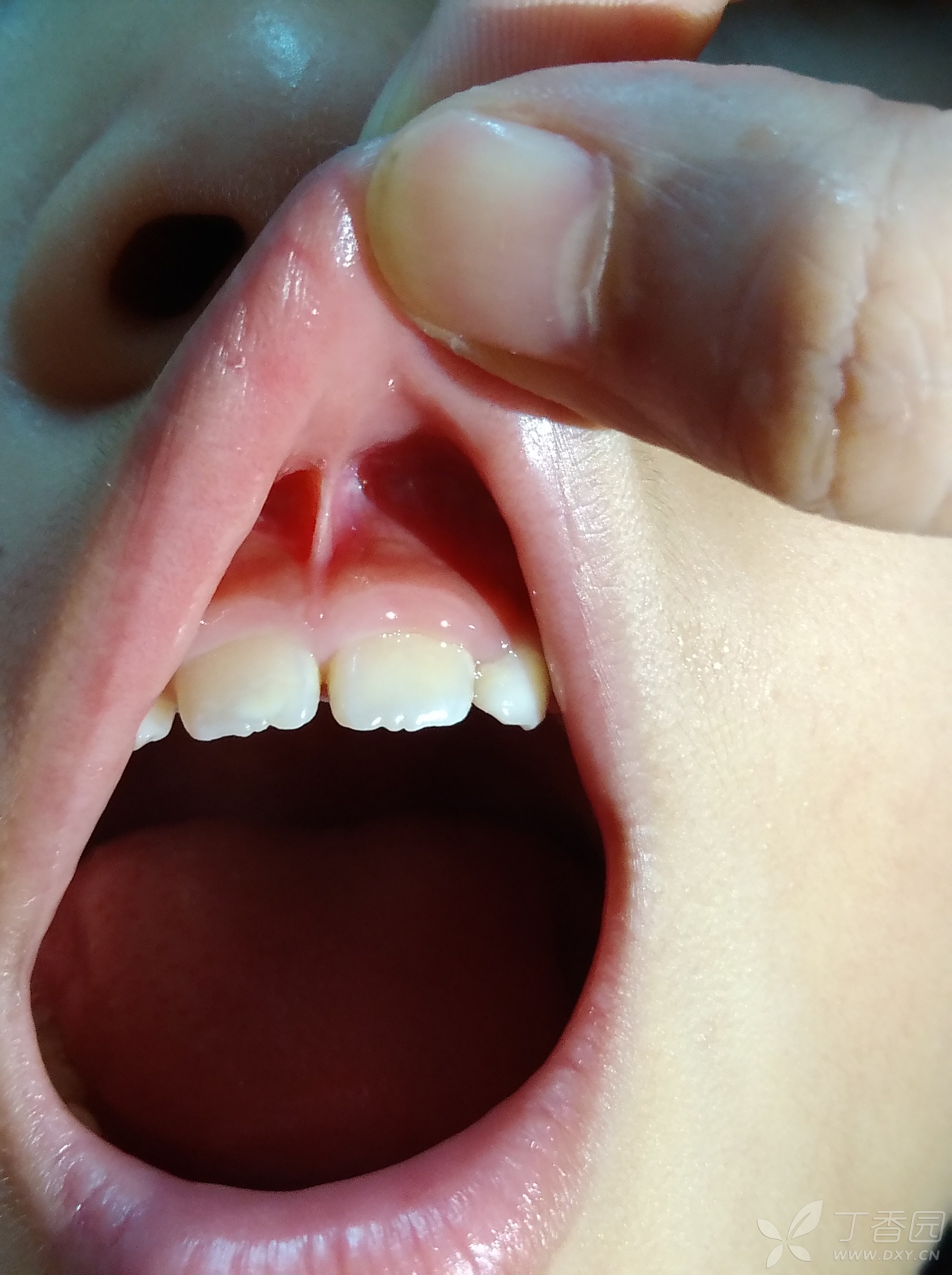 婴儿上唇系带正常图片