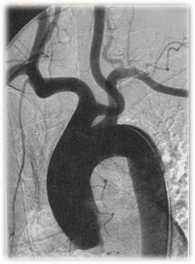 主动脉弓钙化x线图片图片