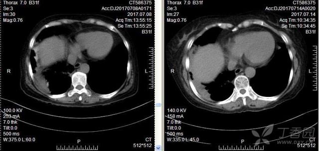 肺部积水能自己吸收吗 3222992217808922163-8w.jpg!w640