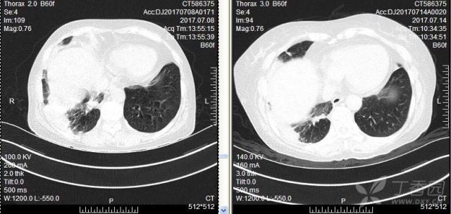 肺部积水能自己吸收吗 3222992211366424677-8w.jpg!w640