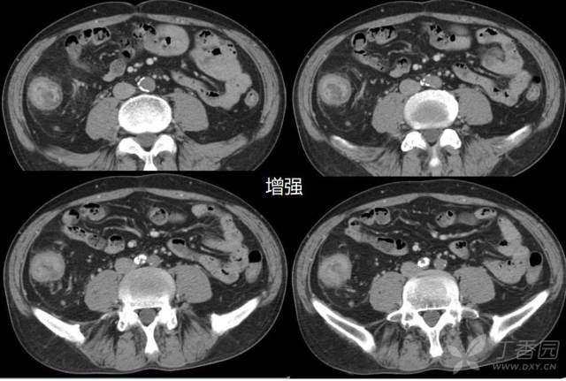 求助各位战友一个病例(病理结果已公布)