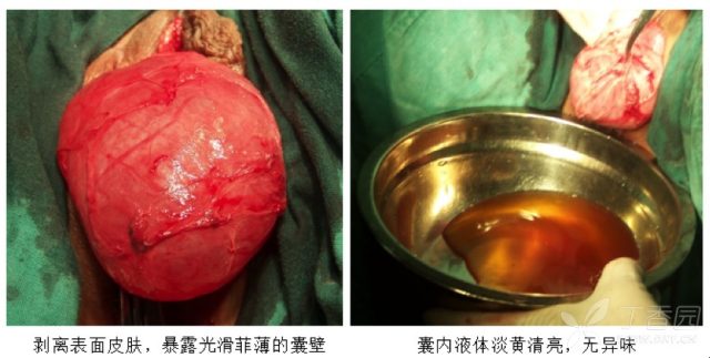 外阴肿物3.png