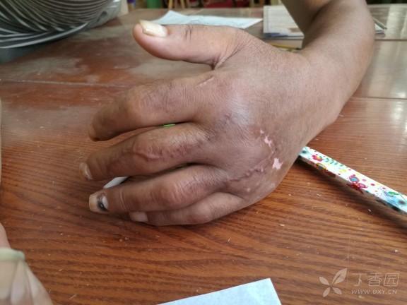 手外伤后瘢痕 [病例帖]