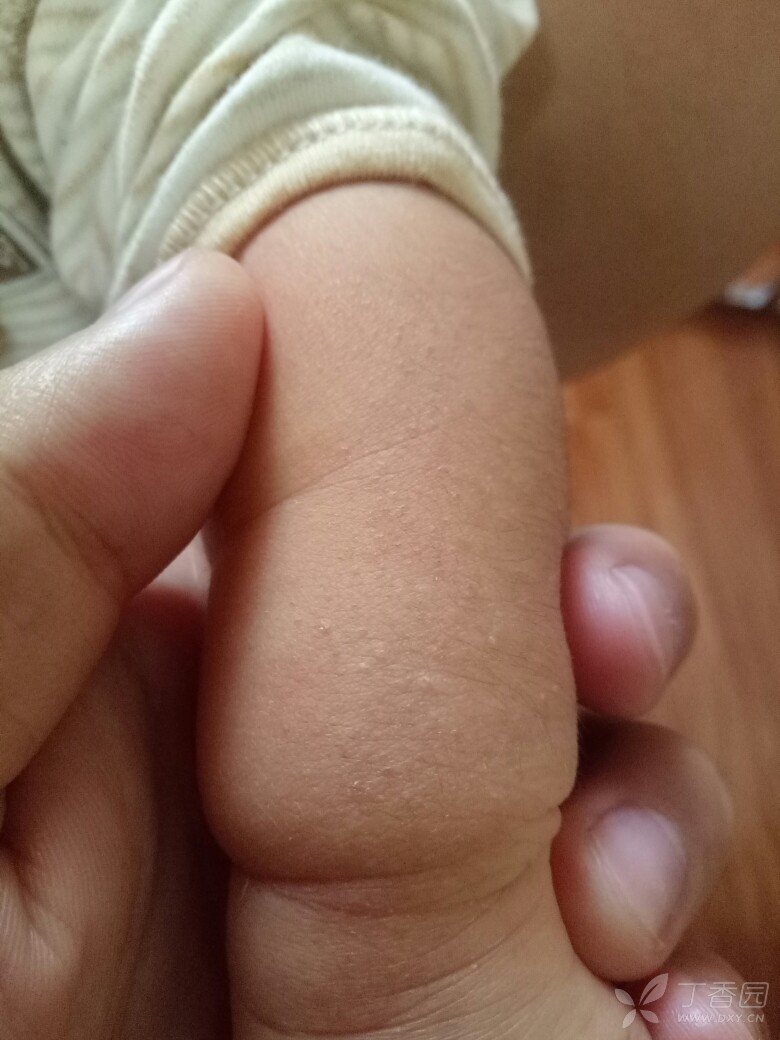 刚出生的婴儿身上长毛