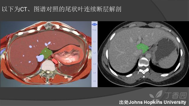 精彩幻灯肝脏断层解剖图谱之尾状叶