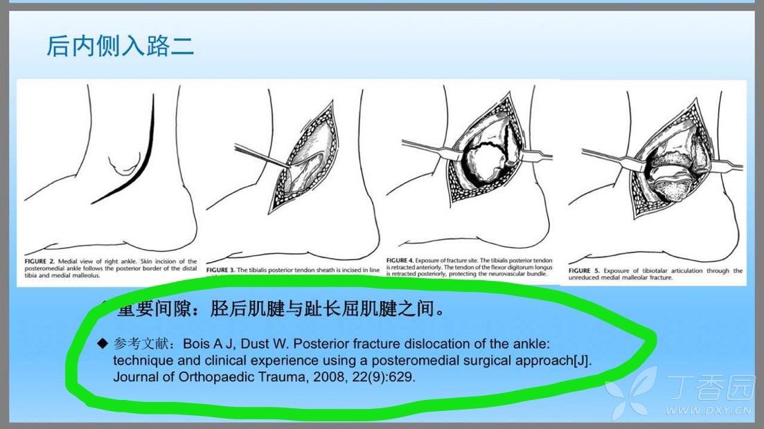 三踝骨折手术入路图谱图片