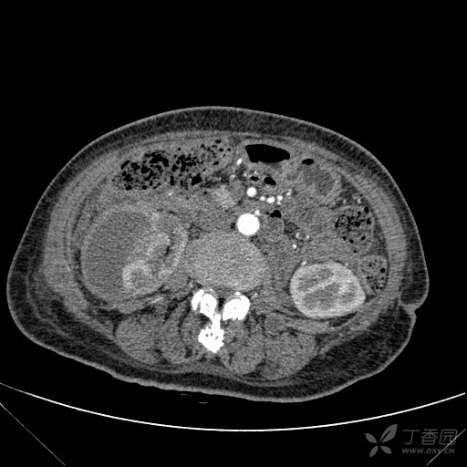 肾包膜下血肿?脓肿?其他?