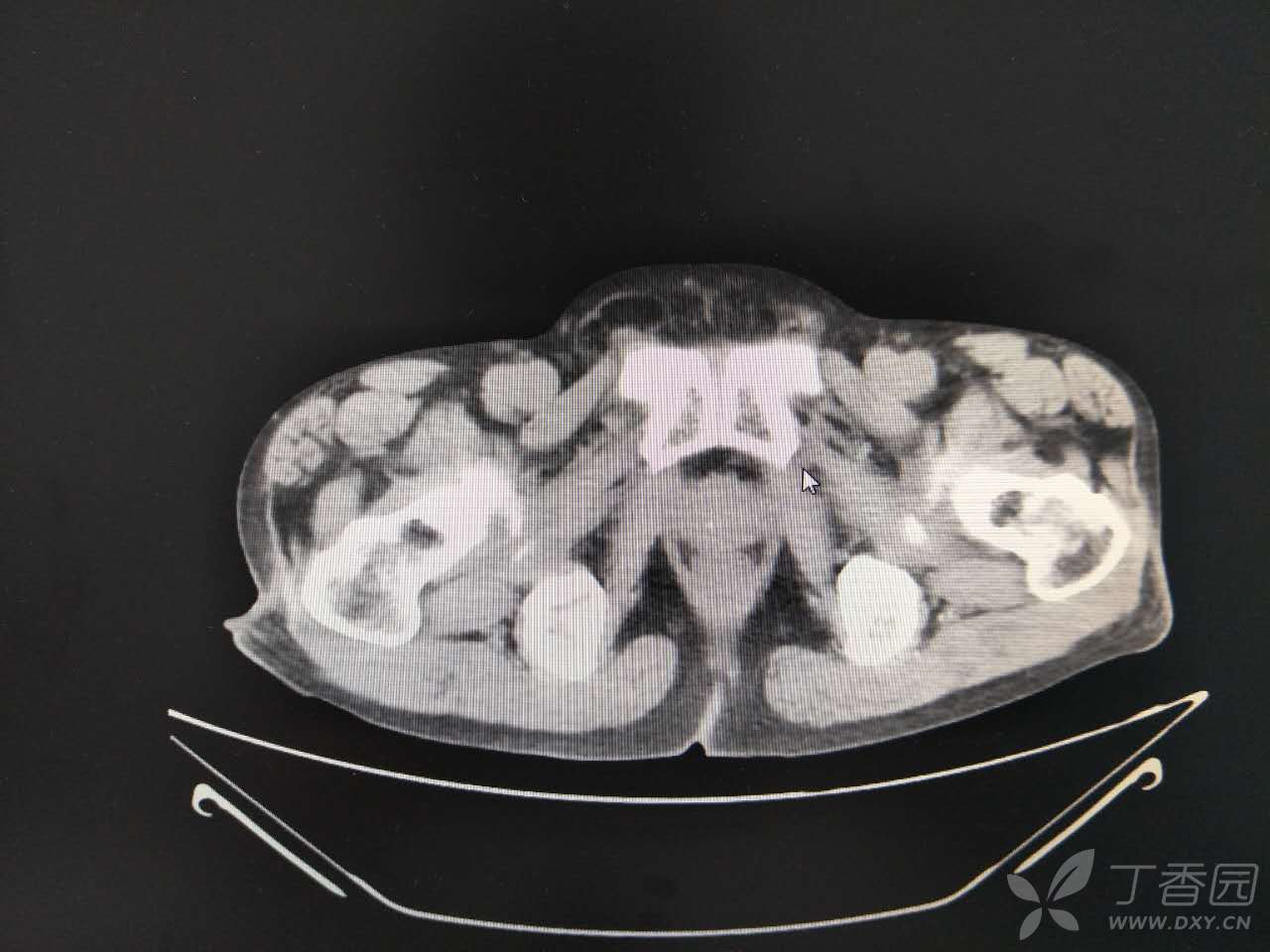 乙状结肠扭转! [病例帖]