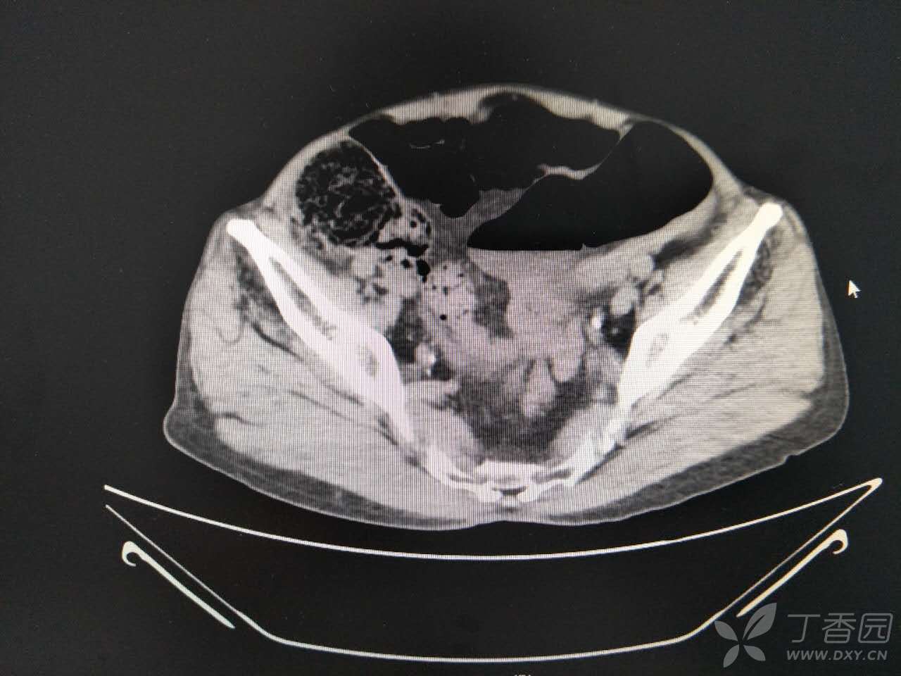 乙状结肠扭转! [病例帖]