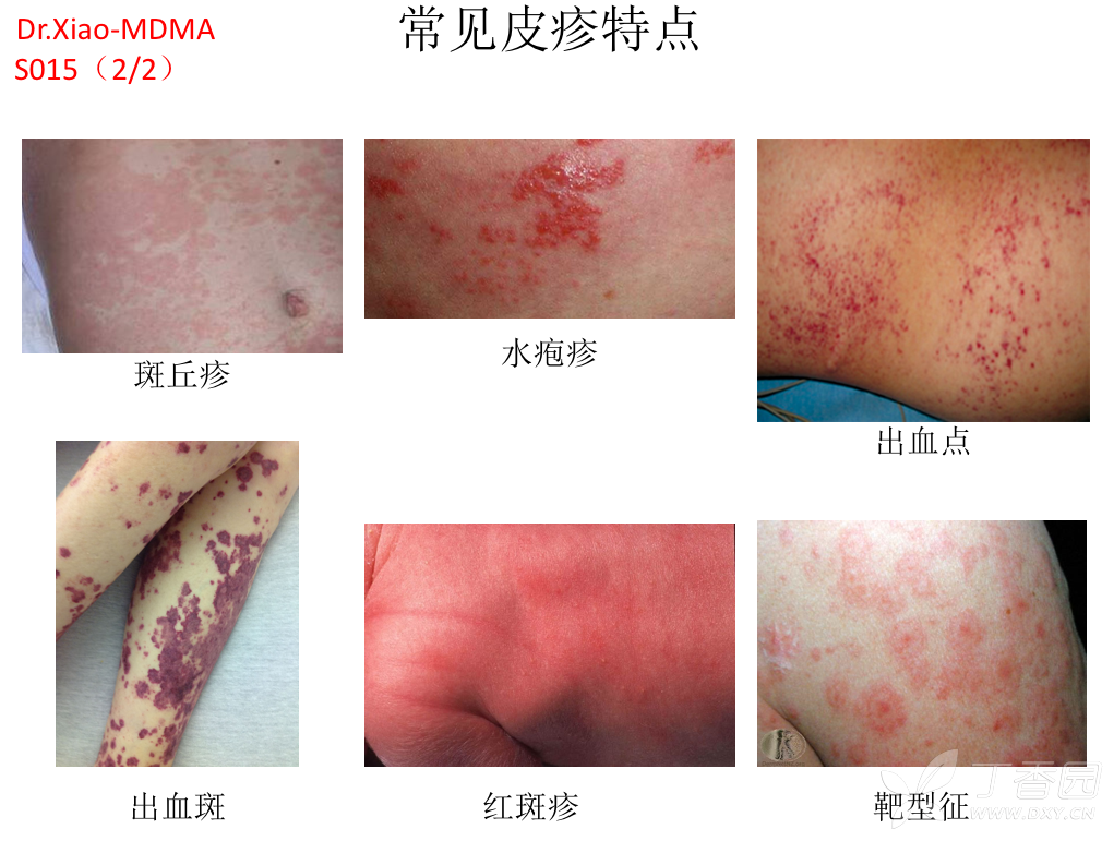 ***:sj综合征是stevens johnson syndrome,dic是弥漫性血管