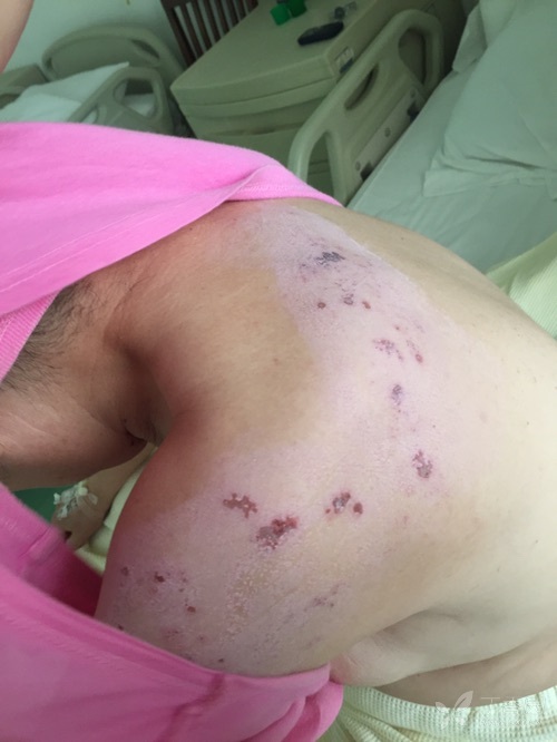 左上肢带状疱疹一例 [病例帖]