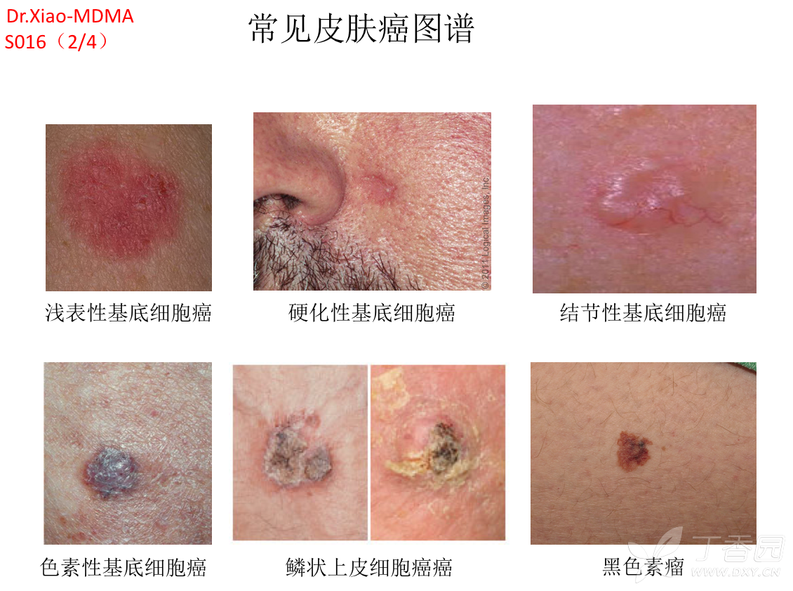 Dr.Xiao-MDMA系列: 皮肤癌及皮肤病变（S016） - 皮肤性病 -丁香园论坛