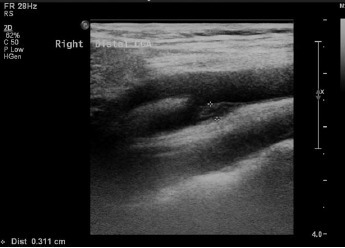 颈动脉局限性增厚 颈动脉管壁局限性增厚：硬化斑块？不，可能是炎症