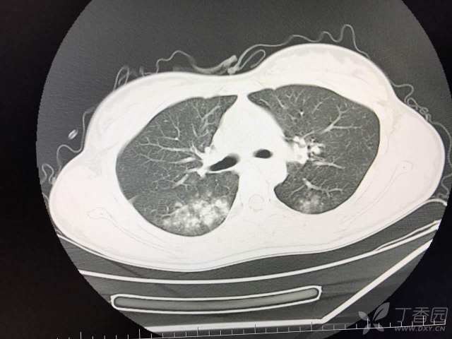 肺部 CT 阅片技巧剖析 障眼法再也不怕了 - 丁香园