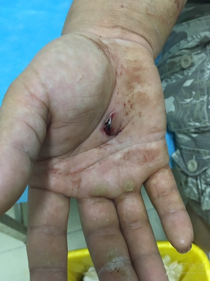 手掌贯通伤一期如何处理 [病例帖]