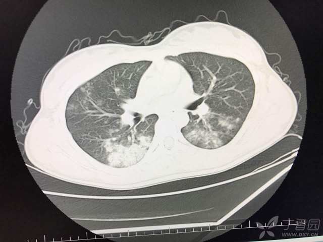 肺部 CT 阅片技巧剖析 障眼法再也不怕了 - 丁香园