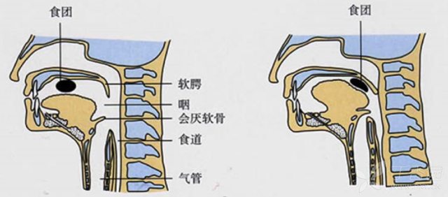 咽反射图片