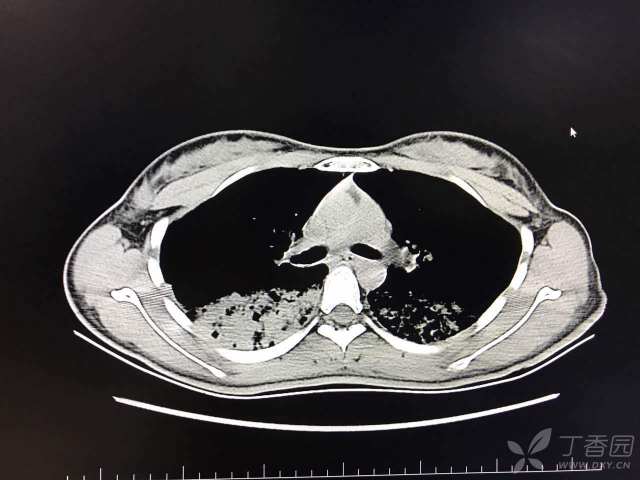 肺部 CT 阅片技巧剖析 障眼法再也不怕了 - 丁香园