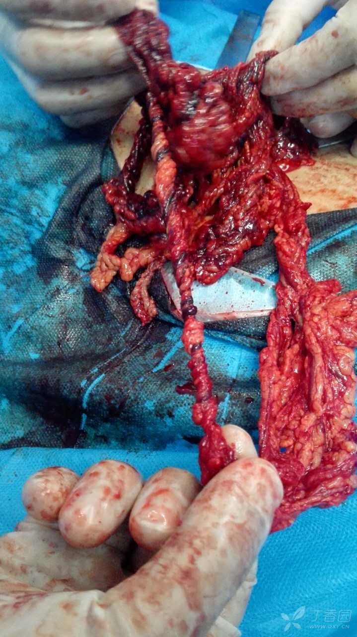 图四:术中所见大网膜扭转情况