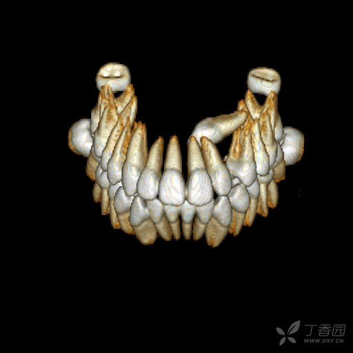 分享一例埋伏牙病例ct重建(非常清晰,漂亮!