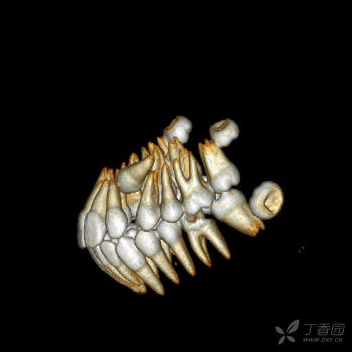 分享一例埋伏牙病例ct重建(非常清晰,漂亮!