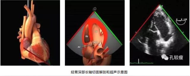 手把手教你做经食管超声心动图（精美图文教学）