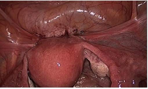 膀胱反折腹膜.png