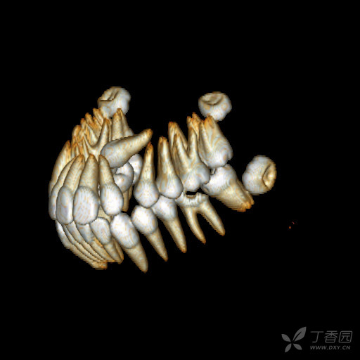 分享一例埋伏牙病例ct重建(非常清晰,漂亮!