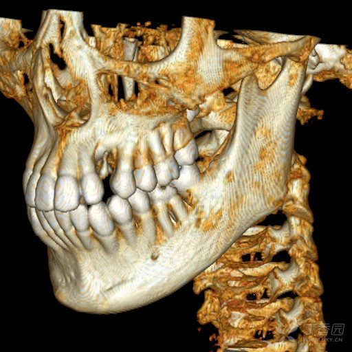 分享一例埋伏牙病例ct重建(非常清晰,漂亮!