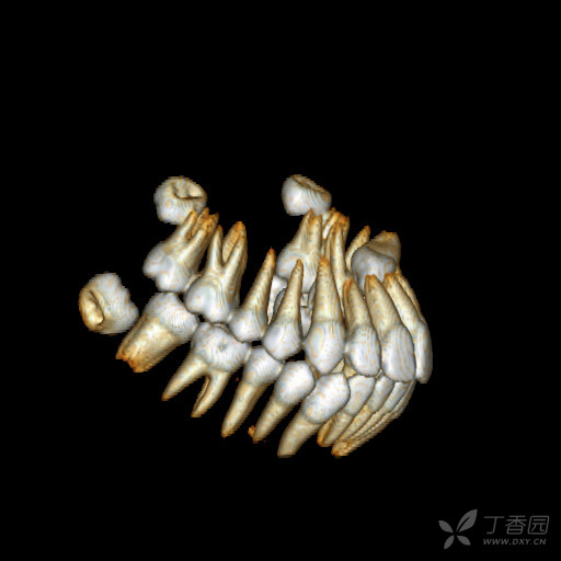分享一例埋伏牙病例ct重建(非常清晰,漂亮!