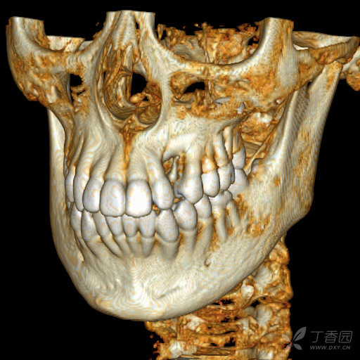 横向埋伏牙图片