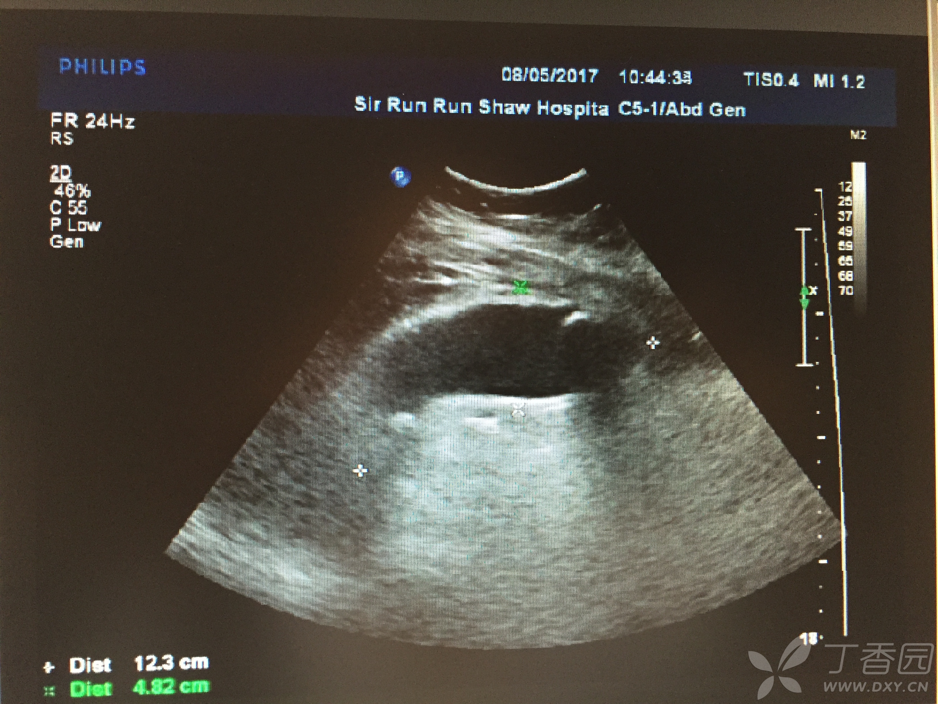 超声培训学习总结day9——胆囊炎,胆囊结石及附睾炎